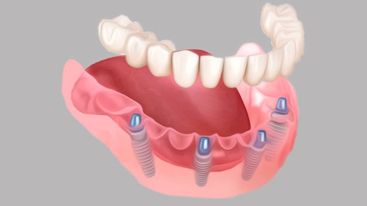 28 000 вместо 100 000. Секрет доступной имплантации зубов в Ульяновске