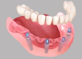 31 158 вместо 100 000. Секрет доступной имплантации зубов в Ульяновске
